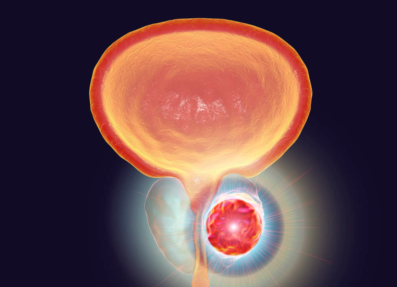 奥拉帕利在美获批用于治疗HRR基因突变的转移性去势抵抗性前列腺癌