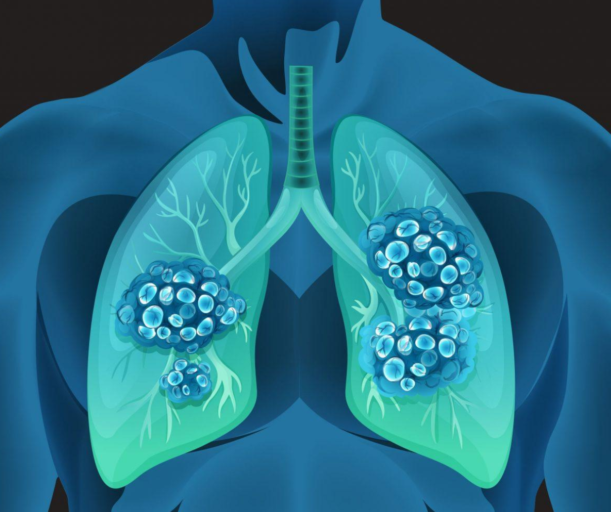 II期试验DESTINY-Lung01的中期分析证明Enhertu在HER2突变型非小细胞肺癌患者治疗中显示出有意义的临床活性