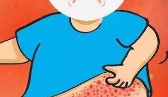 首个国产重组带状疱疹疫苗获准开展临床试验