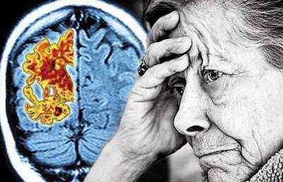 阿尔兹海默症疗法深度报告