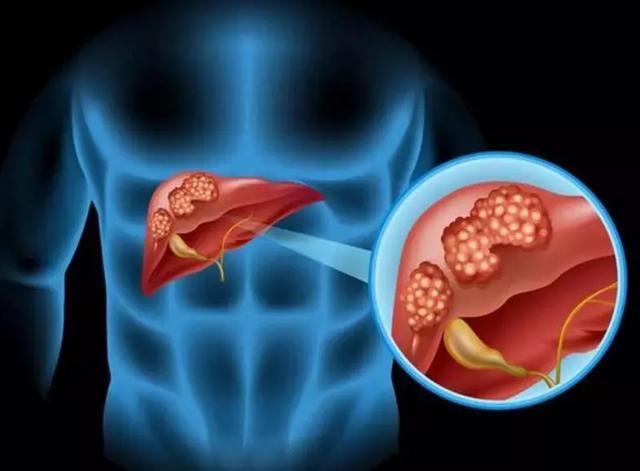 一经发现就是晚期的肝癌，免疫联合治疗成为新的治疗策略