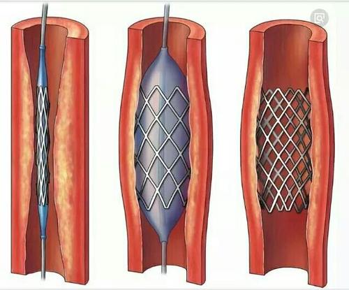 平均降价90%，冠脉扩张球囊从均价3401元下降至319元