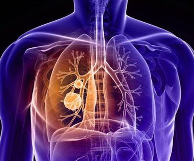 英飞凡在III期不可切除肺癌患者中显示出前所未有的生存获益，43%的患者生存达到五年