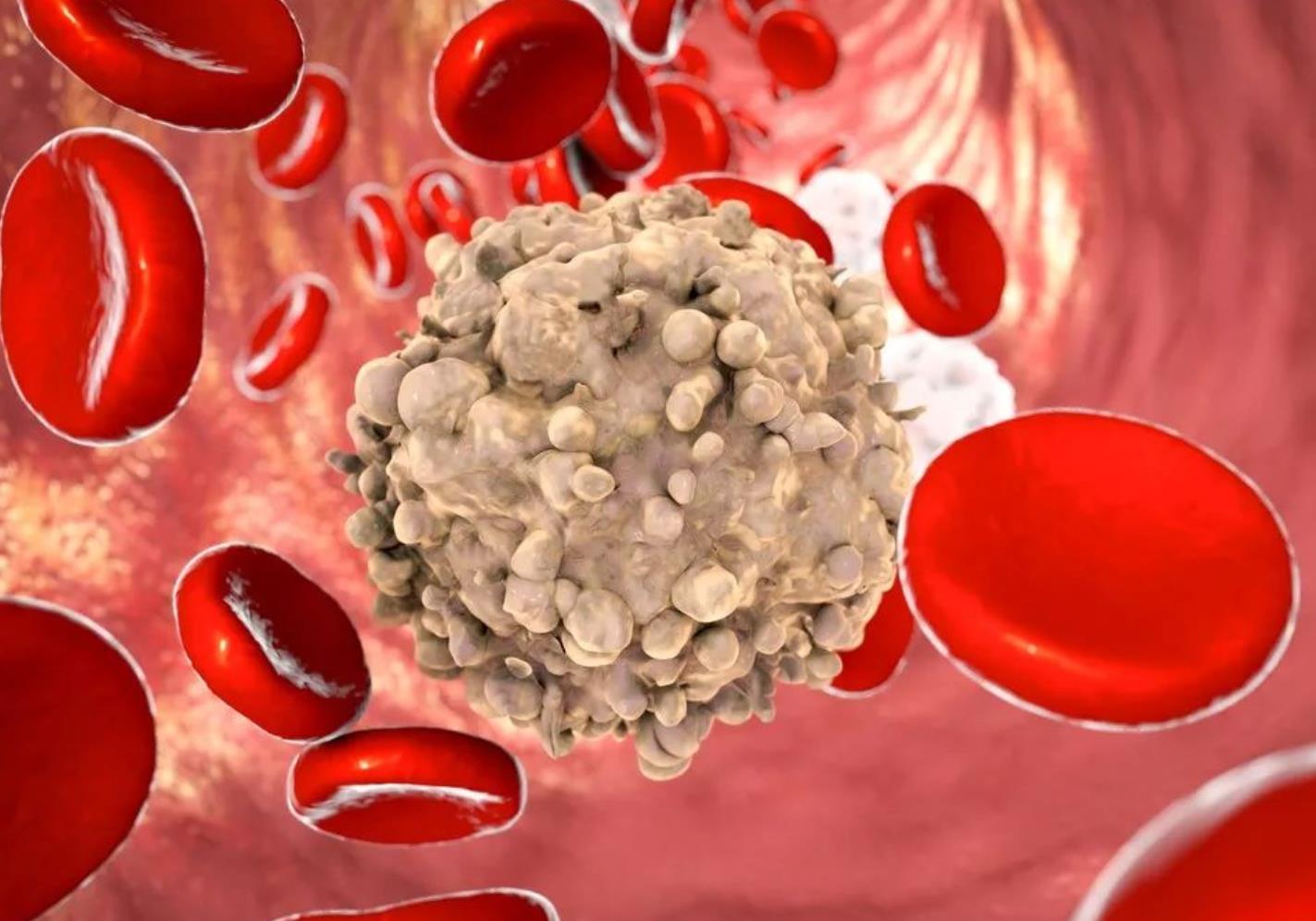 基石药业艾伏尼布一项全球III期研究结果出炉，新诊断突变急性髓系白血病患者迎来新曙光