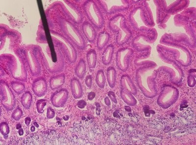全国首例接受CAR-T药品治疗的弥漫性大B细胞淋巴瘤患者CR出院