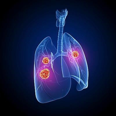 基石药业于ESMO年会公布舒格利单抗重磅研究数据 同步或序贯放化疗患者均获益
