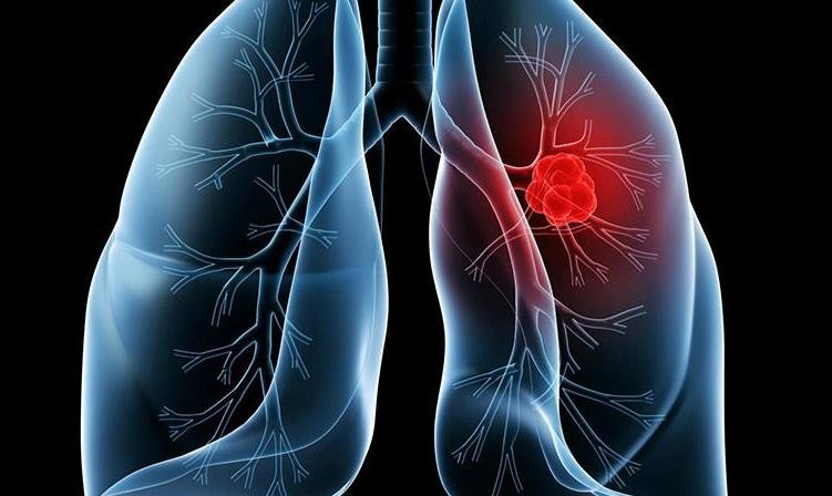 基石药业洛拉替尼治疗ROS1阳性晚期非小细胞肺癌的关键性临床试验申请在中国获批