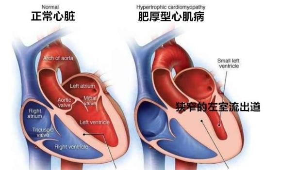 联拓生物宣布Mavacamten在中国获得“突破性治疗药物”认证