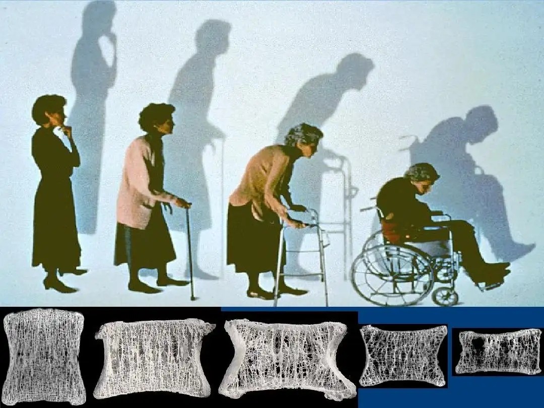 信立泰升级款抗骨质疏松药物特立帕肽注射液获批上市