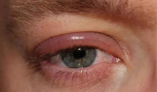 联拓生物合作伙伴Tarsus Pharmaceuticals宣布TP-03在治疗蠕形螨睑缘炎的第二项关键试验中获得积极顶线数据