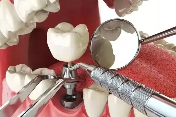 宁波全国首推种植牙医保限价支付政策，国产牙限定3000元/颗