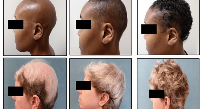 至少可恢复80%头发生长，又一款斑秃治疗产品或要来了