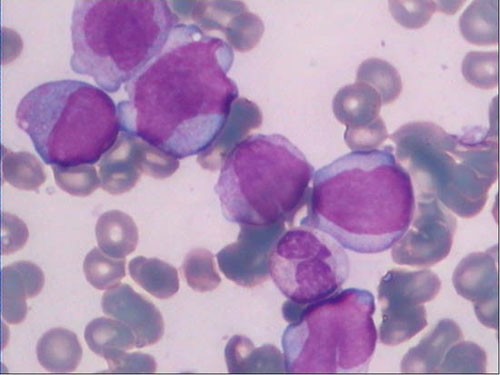 全球首个！基石药业拓舒沃（艾伏尼布片）联合阿扎胞苷疗法获FDA批准用于一线治疗初治的IDH1突变AML患者