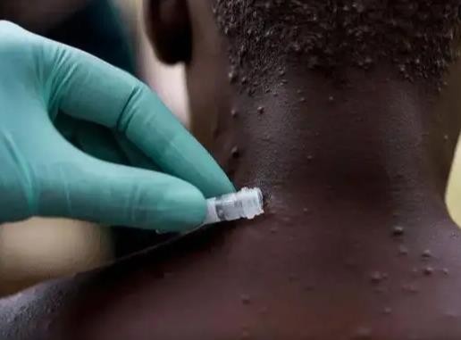 猴痘疫苗Imvanex在欧盟获批上市