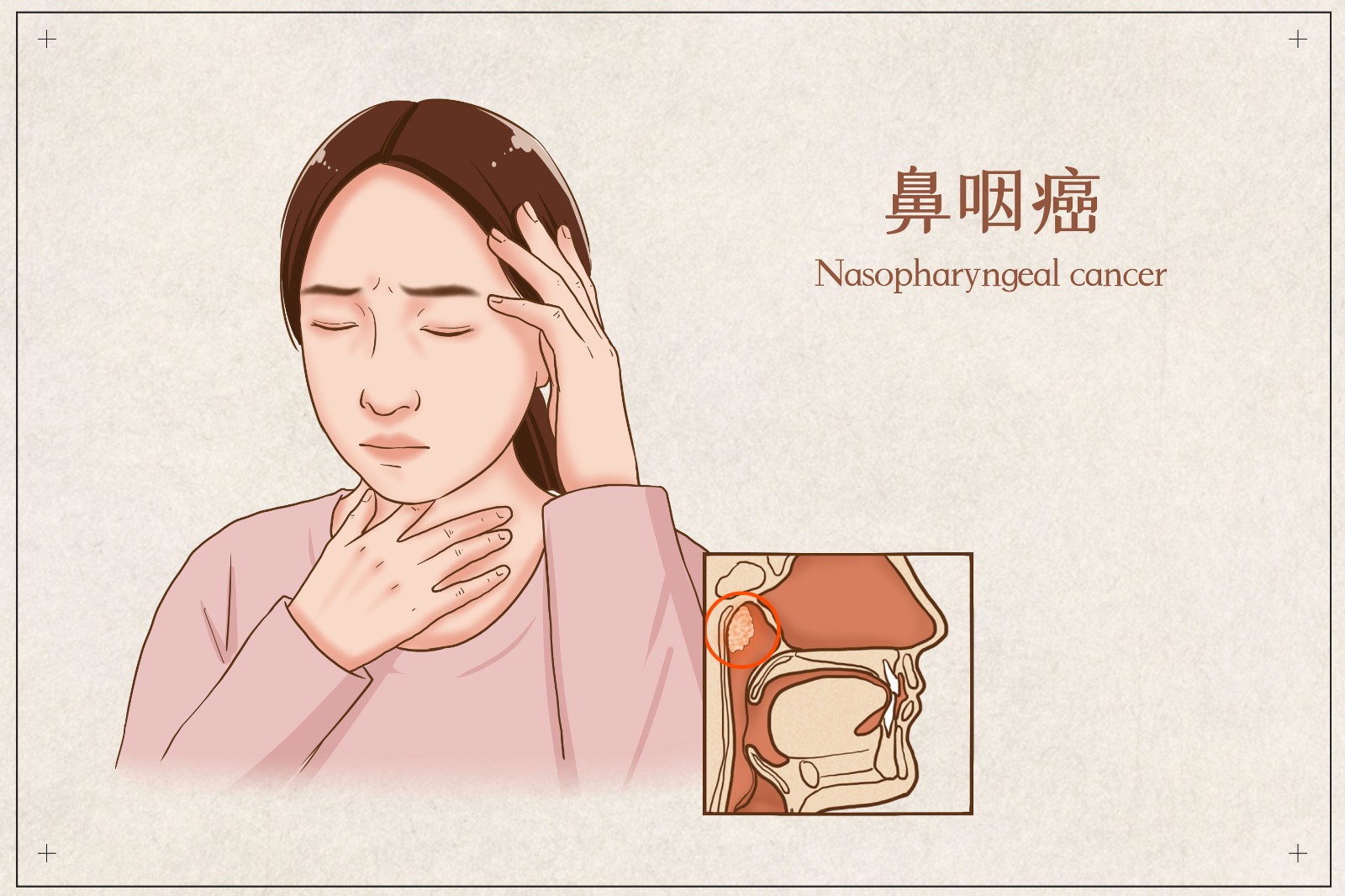 乐普生物EGFR ADC治疗鼻咽癌拟纳入突破性疗法