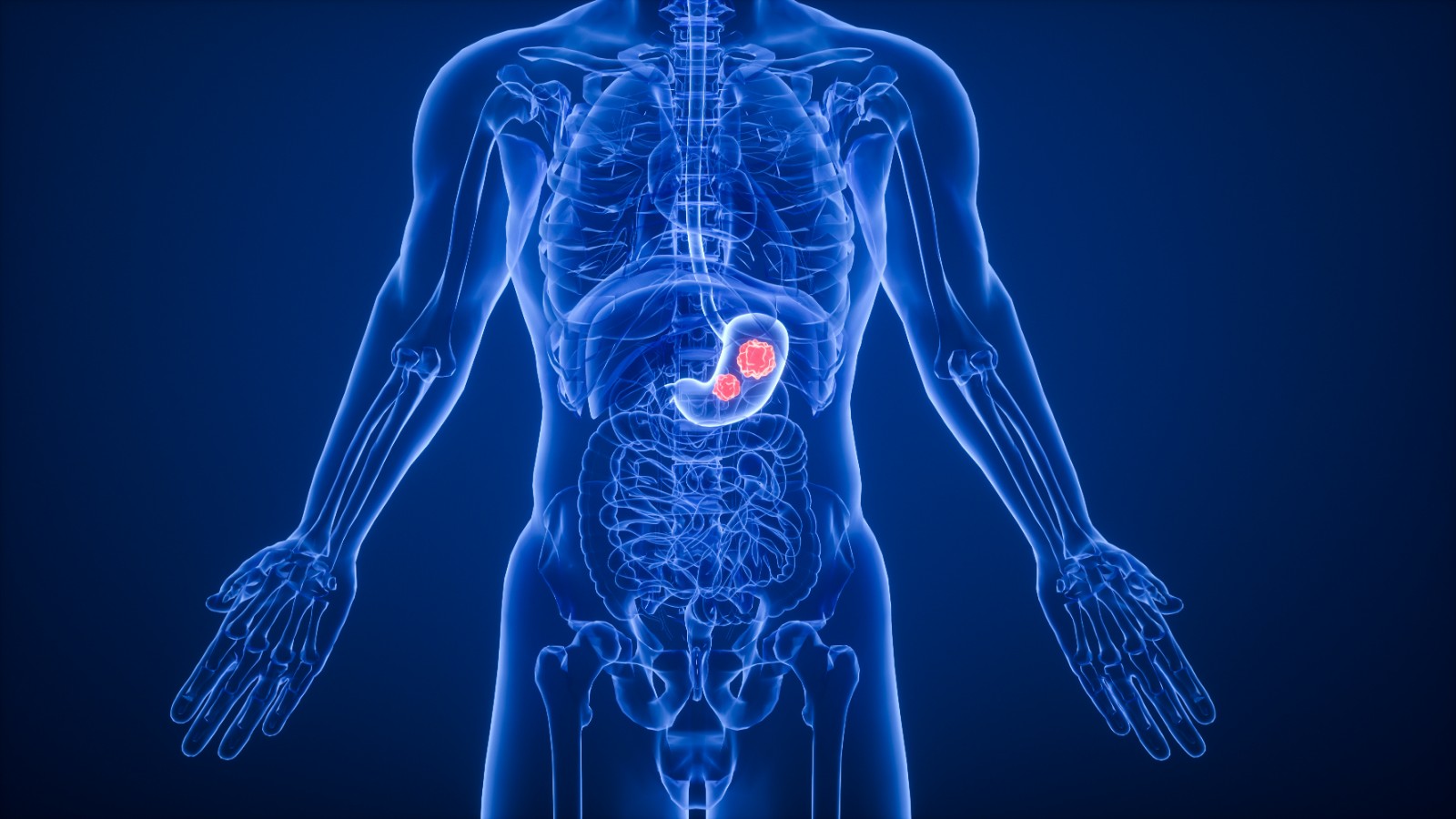 安斯泰来Zolbetuximab一线治疗Claudin 18.2阳性、HER2阴性的局部晚期或转移性胃癌及胃食管交界处腺癌患者的III期临床试验达到主要终点