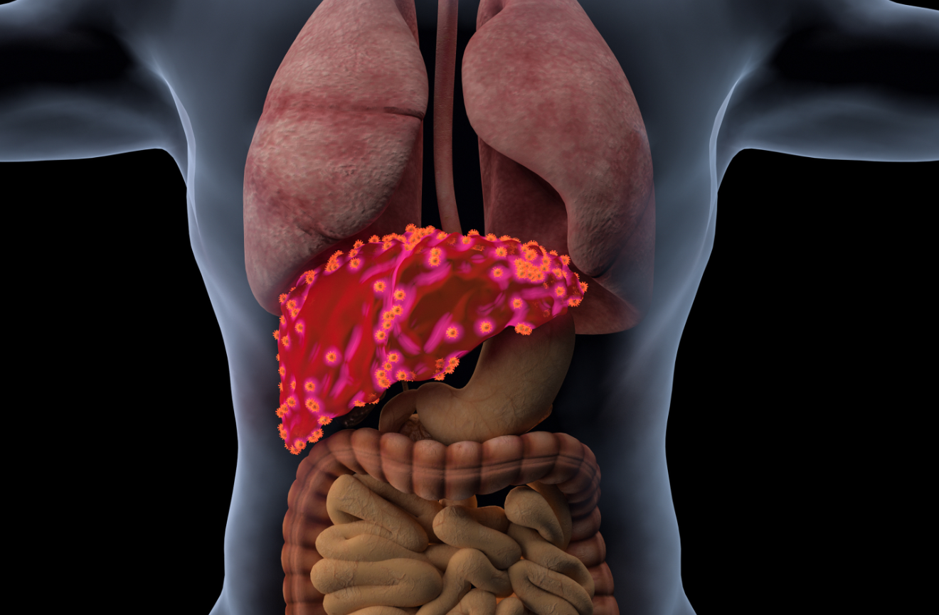 Imjudo联合英飞凡一线治疗不可切除肝癌的Ⅲ期临床研究结果公布