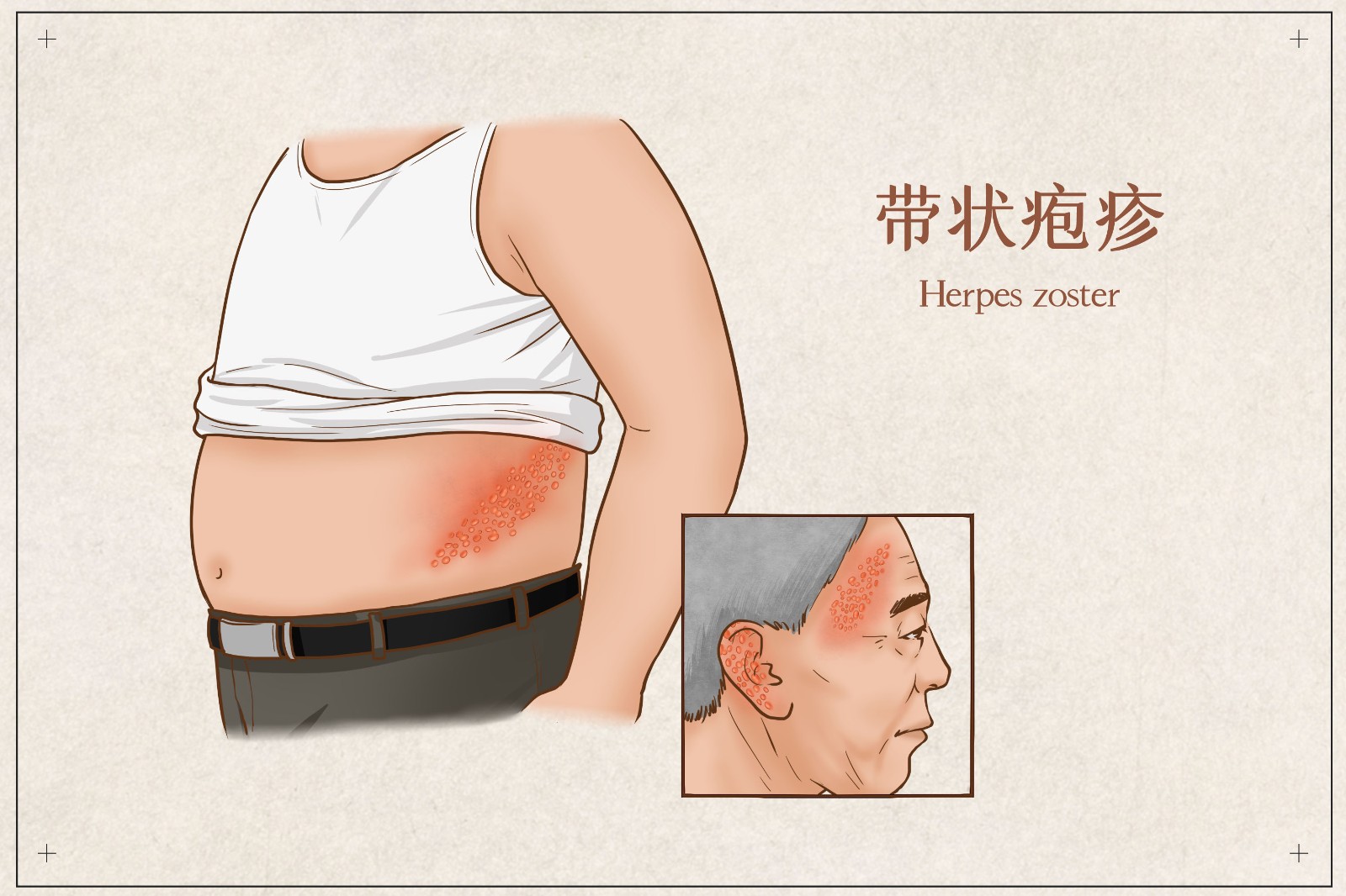 500-800元一针，绿竹生物披露未上市带状疱症疫苗价格