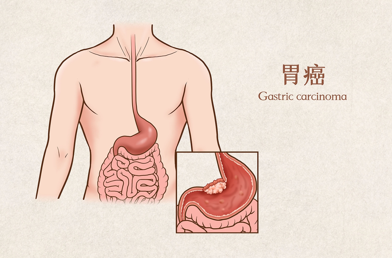 精准施策靶向发力，大咖专家解码胃癌治疗新突破