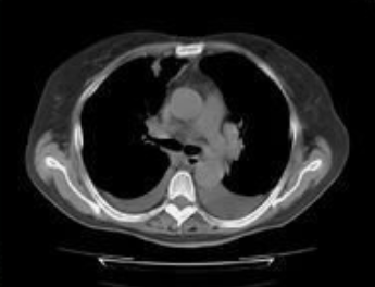 美国FDA批准备思复联合帕博利珠单抗用于特定膀胱癌患者