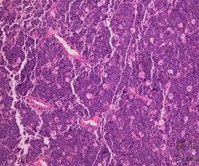 套细胞淋巴瘤患者迎来新希望！全球首个非共价BTK抑制剂匹妥布替尼纳入2025基本医保目录