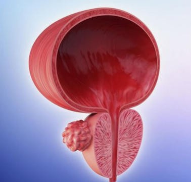 备思复联合帕博利珠单抗显著改善肌层浸润性膀胱癌患者的生存期，无论患者能否耐受顺铂