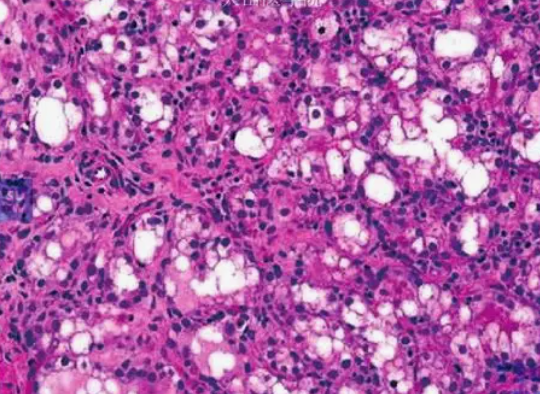 优赫得®在华获批为首个用于既往在转移性疾病阶段经一种或一种以上内分泌治疗进展的HER2低表达或超低表达乳腺癌患者的HER2靶向疗法