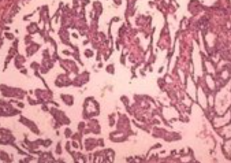 优赫得®在华获批治疗既往接受过一种含曲妥珠单抗治疗方案的局部晚期或转移性HER2阳性成人胃或胃食管结合部腺癌患者