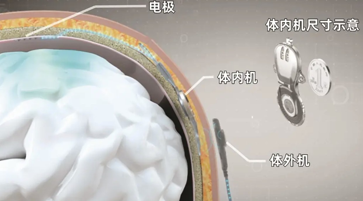 全球首个侵入式脑机接口医疗器械获批上市