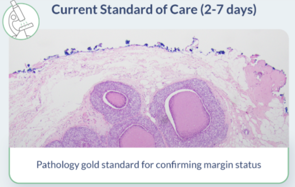 首款AI乳腺癌手术切缘设备获FDA批准
