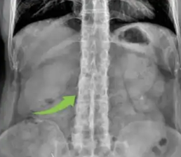 世界强直日 ：腰背疼痛别硬扛！专家：抗炎抑骨、规范治疗，人生可以游刃有余