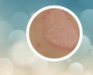 武田制药Zasocitinib(泽索昔替尼)3期银屑病研究数据公布